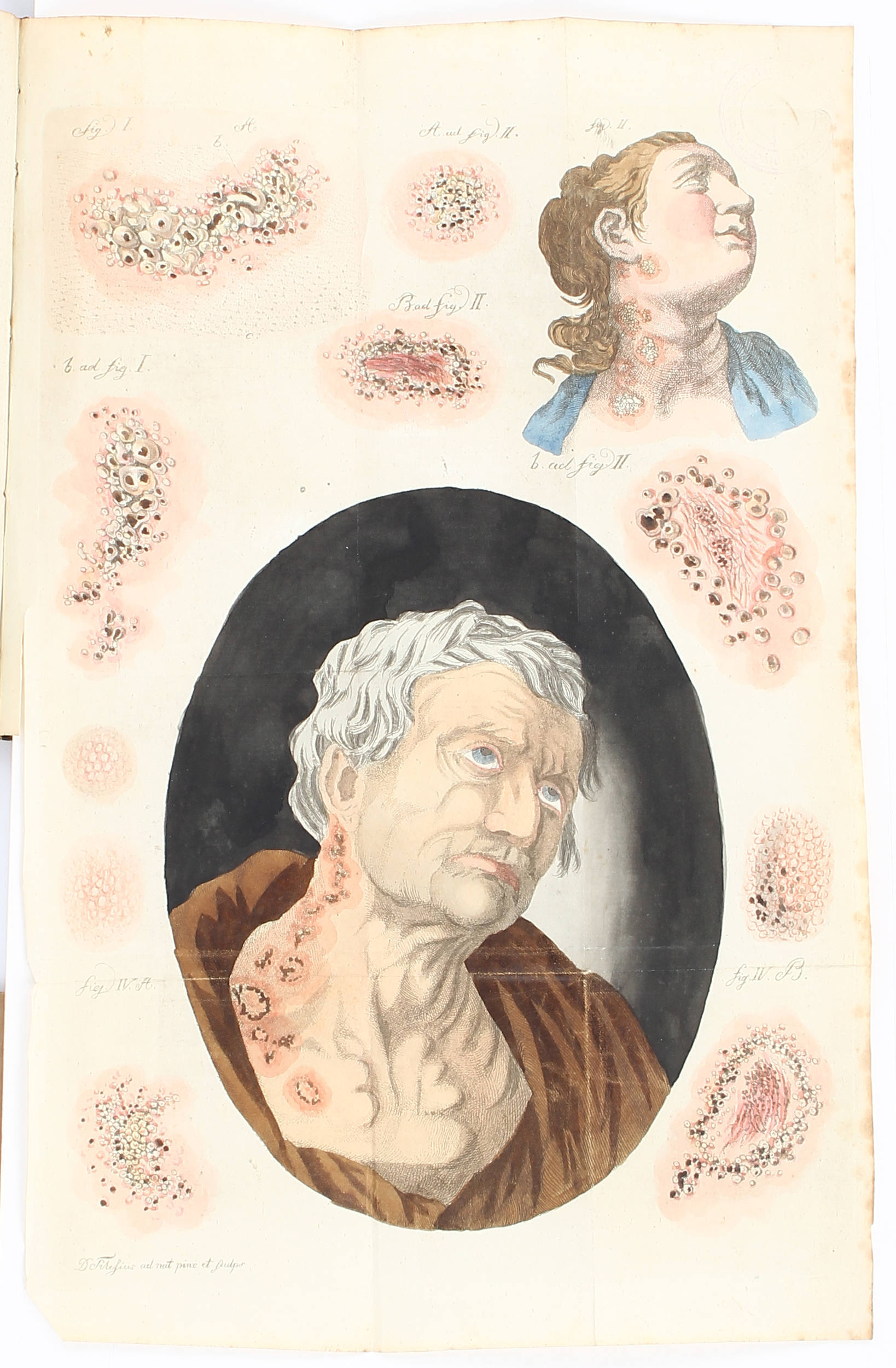 Tilesius, Theorie der flechtenartigen Ausschläge