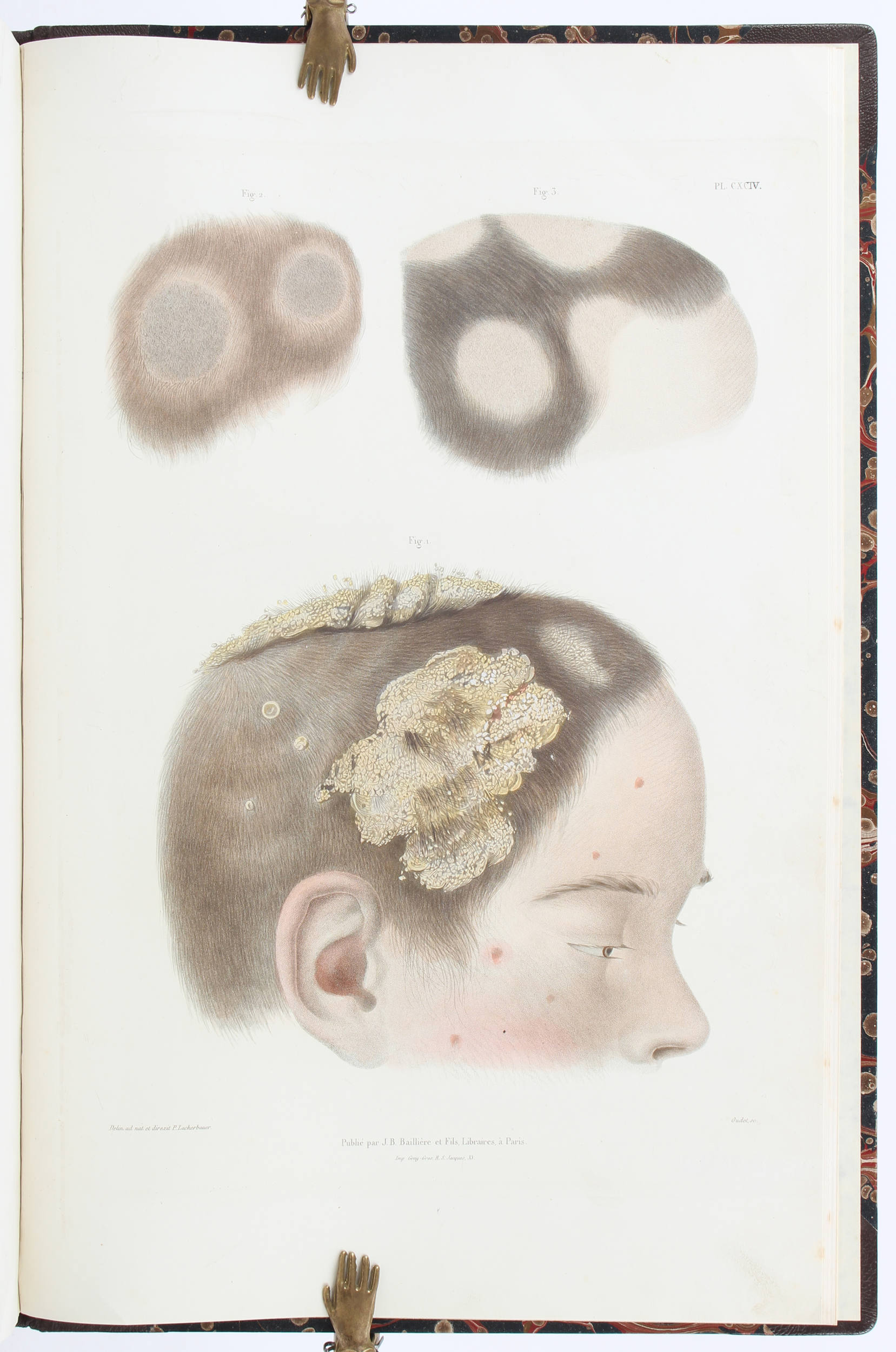 Lebert, Traité d'anatomie. 5 Bde.