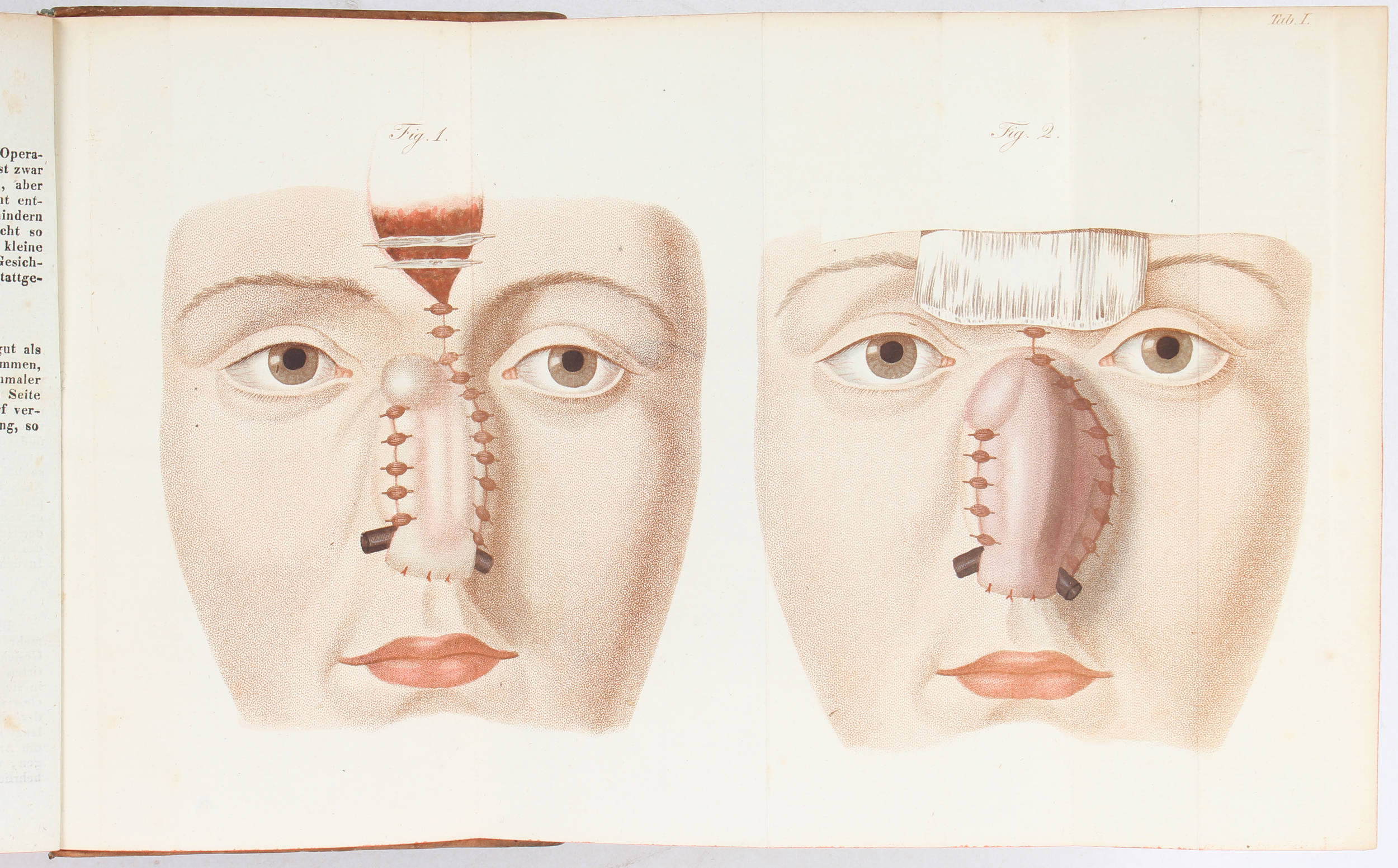 Zeis, Plastische Chirurgie